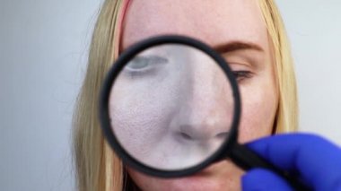 Genişlemiş gözenekler, siyah noktalar, sivilceler, yanakta yakın plan rosacea. Bir kadın bir doktor tarafından muayene ediliyor. Dermatolog deriyi büyüteçle inceliyor, büyüteçle.