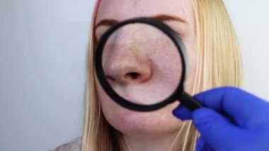 Genişletilmiş rosacea, gözenekler, siyah noktalar, sivilceler, burun üstüne yakın plan. Bir kadın bir doktor tarafından muayene ediliyor. Dermatolog deriyi büyüteçle inceliyor, büyüteçle. 