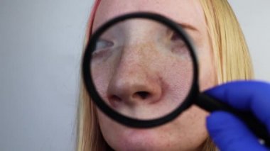 Genişletilmiş rosacea, gözenekler, siyah noktalar, sivilceler, burun üstüne yakın plan. Bir kadın bir doktor tarafından muayene ediliyor. Dermatolog deriyi büyüteçle inceliyor, büyüteçle. 