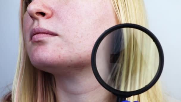 虫眼鏡の下でにきび後 にきび跡の皮膚 皮膚科医との約束で女性 — ストック動画