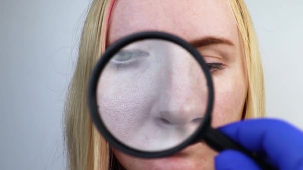 Förstorade Porer Svarta Fläckar Akne Rosacea Närbild Kinden Kvinna Undersöks — Stockvideo