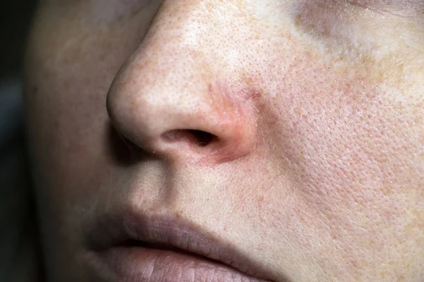 一个年轻女子鼻子上的割草病 痤疮在脸上 由医生进行检查 — 图库照片