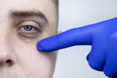 Gözlerinin altında torbalar, bir adamın yüzünde fıtık. Plastik cerrah, blefaroplasti yapmadan önce bir hastayı muayene eder.