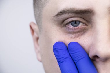 Gözlerinin altında torbalar, bir adamın yüzünde fıtık. Plastik cerrah, blefaroplasti yapmadan önce bir hastayı muayene eder.