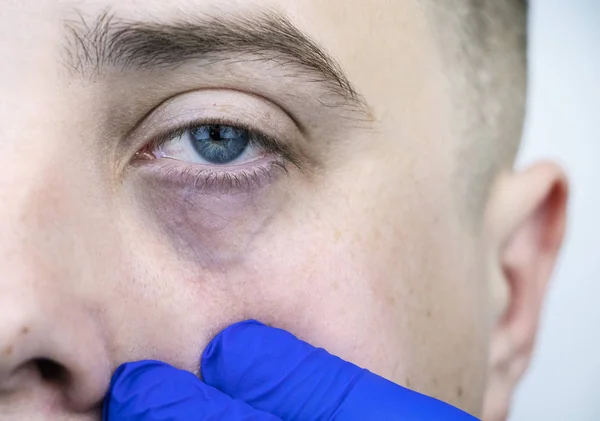Bags under the eyes, hernias on the face of a man. Plastic surgeon examines a patient before blepharoplasty