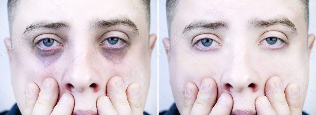 Bags under the eyes, hernias on the face of a man. Plastic surgeon examines a patient. Before and after blepharoplasty