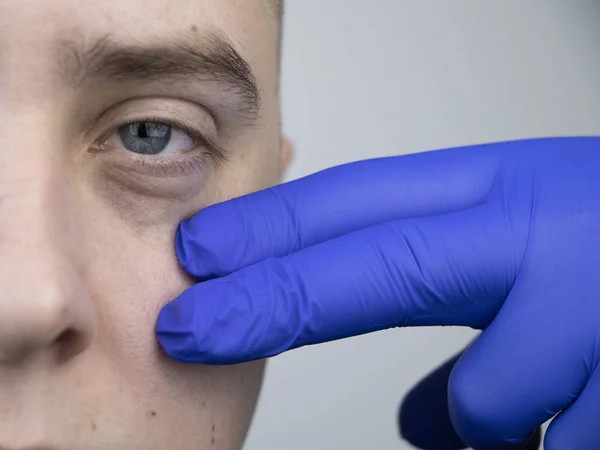 Bags under the eyes, hernias on the face of a man. Plastic surgeon examines a patient before blepharoplasty