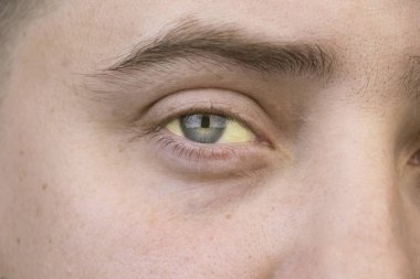 The yellow color of the male eye. Symptom of jaundice, hepatitis or problems with the gall bladder, gastrointestinal tract, liver. clipart