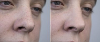 Black dots, clogged pores on the nose of a man close-up. A patient at a beautician appointment. Before and after facial cleansing clipart