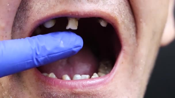 Homem Tem Dentes Podres Dentes Caídos Dentes Amarelos Pretos Feridos — Vídeo de Stock