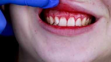 Gum bleeding and inflammation close up. A man examined by a dentist. The diagnosis of gingivitis
