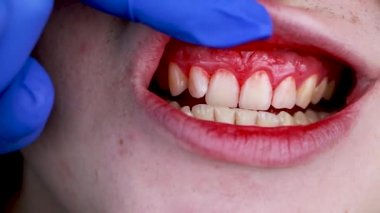 Gum bleeding and inflammation close up. A man examined by a dentist. The diagnosis of gingivitis
