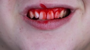 The man has blood on his teeth, severe bleeding of the gums after a blow to the jaw. Close-up of teeth after a fight or bruise