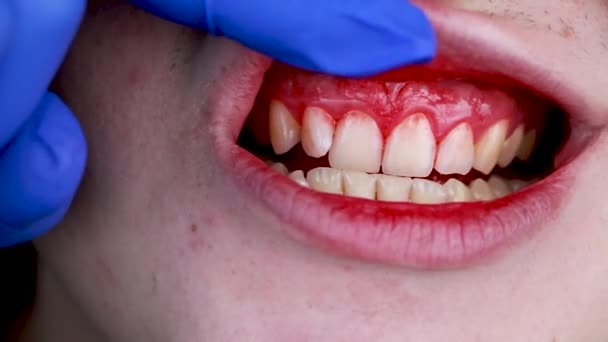 Gum Bleeding Inflammation Close Man Examined Dentist Diagnosis Gingivitis — Stok video