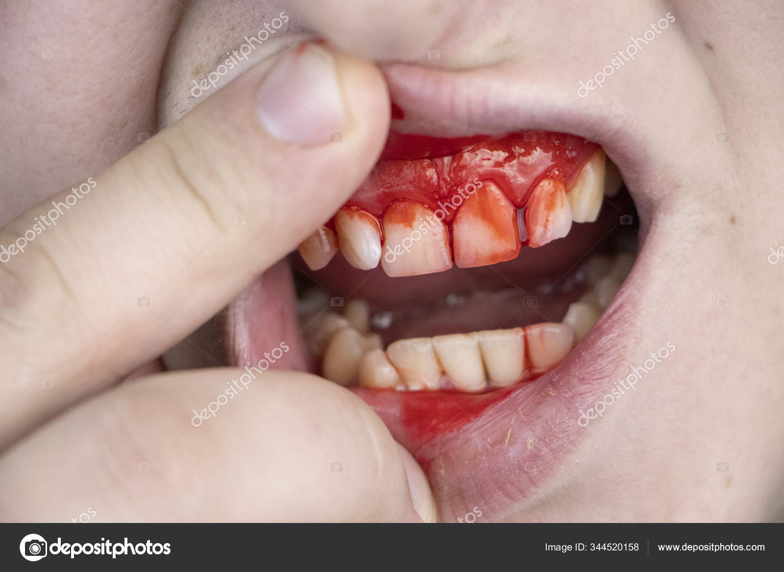 Manden Har Blod Tænderne Alvorlig Blødning Gummerne Efter Slag Kæben —  Stockfoto © Alena1919 #344520158, image size:1600x1167
