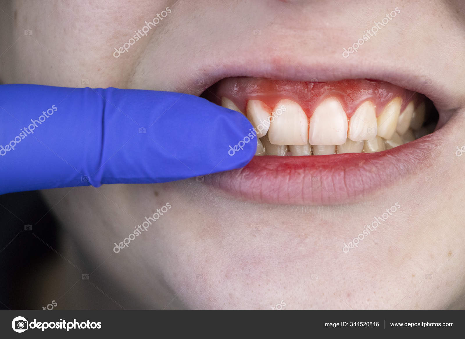 Tyggegummi Blødning Betændelse Tæt Mand Undersøgt Tandlæge Diagnosen  Tandkødsbetændelse — Stockfoto © Alena1919 #344520886, image size:1600x1167