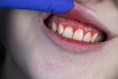 Gum bleeding and inflammation close up. A man examined by a dentist. The diagnosis of gingivitis