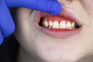 Gum bleeding and inflammation close up. A man examined by a dentist. The diagnosis of gingivitis