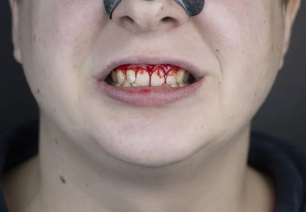 The man has blood on his teeth, severe bleeding of the gums after a blow to the jaw. Close-up of teeth after a fight or bruise