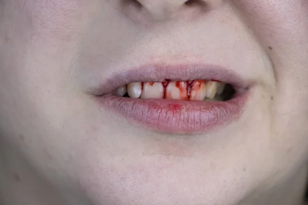 Man Has Blood His Teeth Severe Bleeding Gums Blow Jaw — 图库照片
