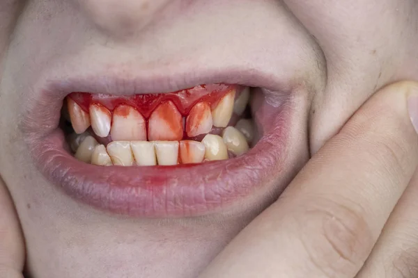 Man Has Blood His Teeth Severe Bleeding Gums Blow Jaw — Stock Photo, Image