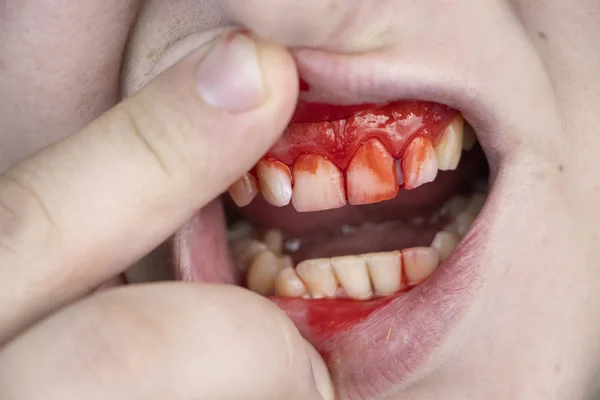 The man has blood on his teeth, severe bleeding of the gums after a blow to the jaw. Close-up of teeth after a fight or bruise