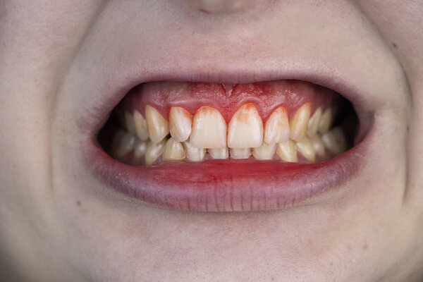 Gum bleeding and inflammation close up. A man examined by a dentist. The diagnosis of gingivitis