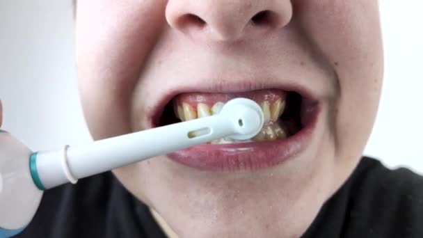 歯茎の出血や炎症が閉じます 男は電気ブラシで歯を磨き歯茎が出血している — ストック動画