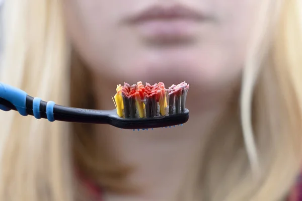 Toothbrush with blood closeup. A woman discovered bleeding gums while brushing her teeth. Gingivitis or periodontal disease