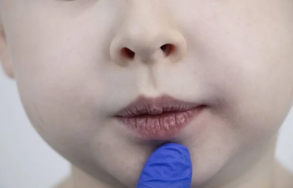 Chapped and dry lips in a child. A boy examined by a pediatrician in a hospital. Pediatrician examines lip peeling