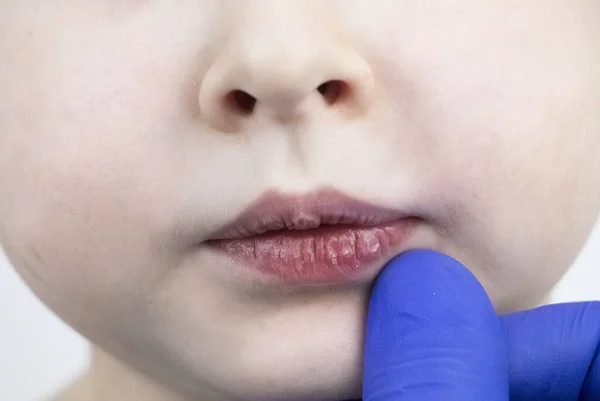 Lábios Rachados Secos Uma Criança Rapaz Examinado Por Pediatra Num — Fotografia de Stock