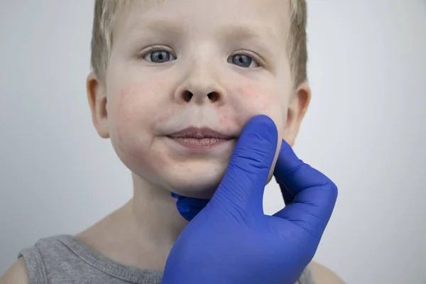 Alergia Forma Enrojecimiento Cara Erupciones Cutáneas Prische Niño Niño Examinado — Foto de Stock