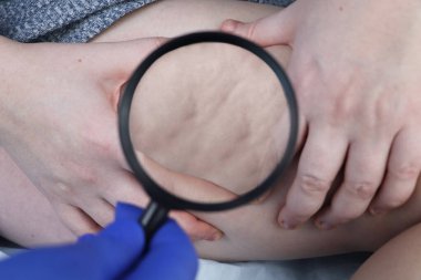 Doktor, hastanın bacağını lipodirofi ile muayene eder. Bir büyüteç selüliti gösterir. Obezite ve liposkleroz tedavisi kavramı, portakal kabuğu