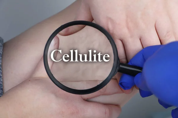 A doctor examines a patients leg with lipodystrophy. A magnifying glass shows cellulite. The concept of obesity and treatment of liposclerosis, orange peel