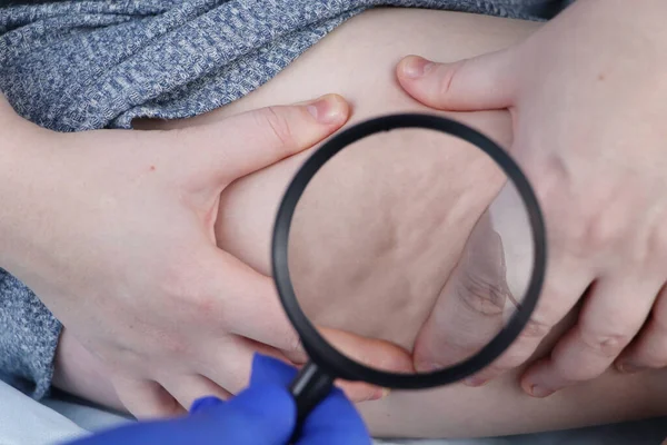 A doctor examines a patients leg with lipodystrophy. A magnifying glass shows cellulite. The concept of obesity and treatment of liposclerosis, orange peel