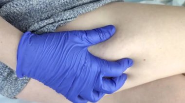 Bir damar cerrahı varisli bacağı muayene eder. Vasküler ağ ve kan damarları büyüteçle yakından gösteriliyor. Lazer tedavisi ve skleroterapi için hazırlık