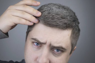 Bir tricholog, büyüteç altındaki genç bir adamı muayene ediyor. Daha önce saç ve pigmentlerin beyazlaması, vücuttaki düşük melaninin bir göstergesi.