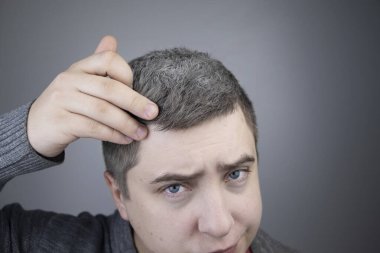 Bir tricholog, büyüteç altındaki genç bir adamı muayene ediyor. Daha önce saç ve pigmentlerin beyazlaması, vücuttaki düşük melaninin bir göstergesi.