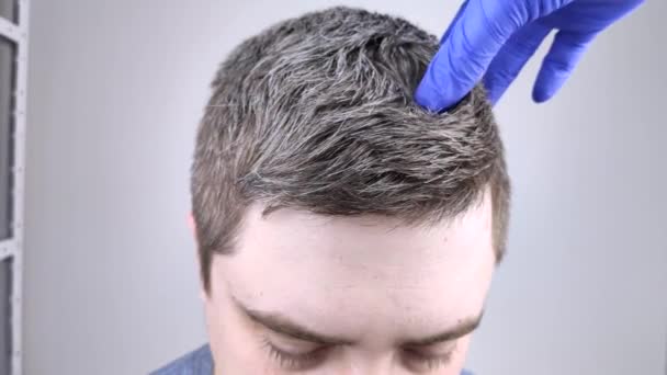 青い医療手袋の医者のトリコロジストは 若い男の白髪を調べます 若い人たちの髪の毛の初期のグレーの概念 — ストック動画