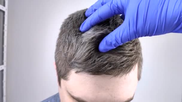 Doctor Trichologist Blue Medical Gloves Examines Gray Hair Young Man — Stock Video