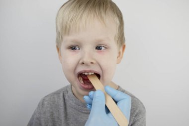 An otolaryngologist examines a child's throat with a wooden spatula. A possible diagnosis is inflammation of the pharynx, tonsils or pharyngitis. The concept of treatment and prevention of childhood diseases clipart