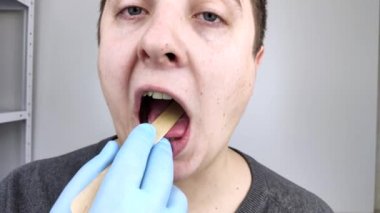 Bir otolaryngolog, tahta bir spatulayla bir adamın boğazını inceliyor. Olası bir teşhis gırtlak iltihabı, bademcik iltihabı veya gırtlak iltihabı olabilir. Boğaz hastalığının tedavisi ve önlenmesi.