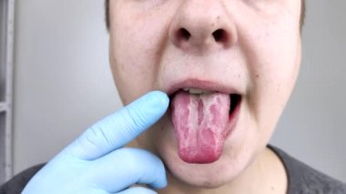 Dilinde beyaz kaymak. Bir doktor ya da gastroenterolog bir erkeğin dilini inceler. Hastanın ağız sağlığı ya da hastalık belirtileri zayıf.