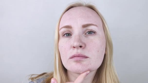 女人在脸上检查干枯的皮肤 皮肤敏感 皮肤科医生或美容师指定的病人 选择用于干燥的乳膏 — 图库视频影像
