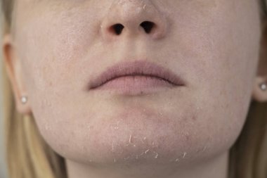 Bir kadın yüzündeki kuru deriyi muayene eder. Soyulma, kabalaşma, rahatsızlık, cilt hassasiyeti. Dermatolog ya da kozmetikçinin randevusundaki hasta, kuruluk için krem seçimi.