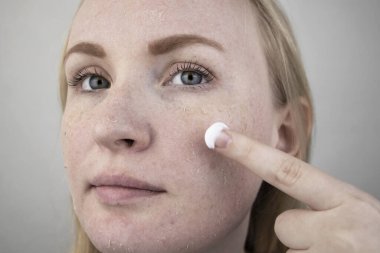 Bir kadın yüzündeki kuru deriyi muayene eder. Soyulma, kabalaşma, rahatsızlık, cilt hassasiyeti. Dermatolog ya da kozmetikçinin randevusundaki hasta, kuruluk için krem seçimi.