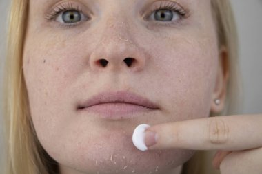 Bir kadın yüzündeki kuru deriyi muayene eder. Soyulma, kabalaşma, rahatsızlık, cilt hassasiyeti. Dermatolog ya da kozmetikçinin randevusundaki hasta, kuruluk için krem seçimi.