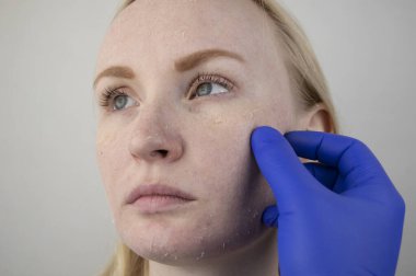 Bir kadın yüzündeki kuru deriyi muayene eder. Soyulma, kabalaşma, rahatsızlık, cilt hassasiyeti. Dermatolog ya da kozmetikçinin randevusundaki hasta, kuruluk için krem seçimi.