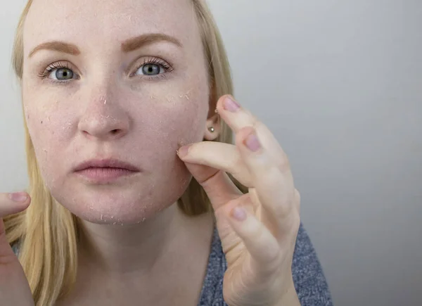 女人在脸上检查干枯的皮肤 皮肤敏感 皮肤科医生或美容师指定的病人 选择用于干燥的乳膏 — 图库照片