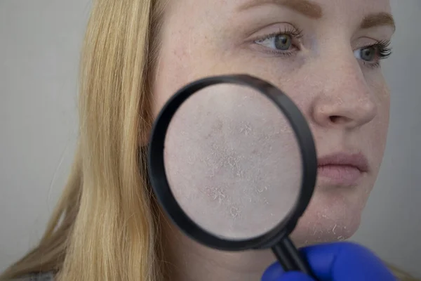 Een Vrouw Onderzoekt Droge Huid Haar Gezicht Schillen Grof Worden — Stockfoto